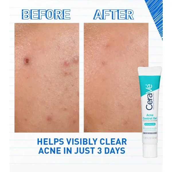 ژل کنترل آکنه سراوی CeraVe Acne Control Gel - Image 3